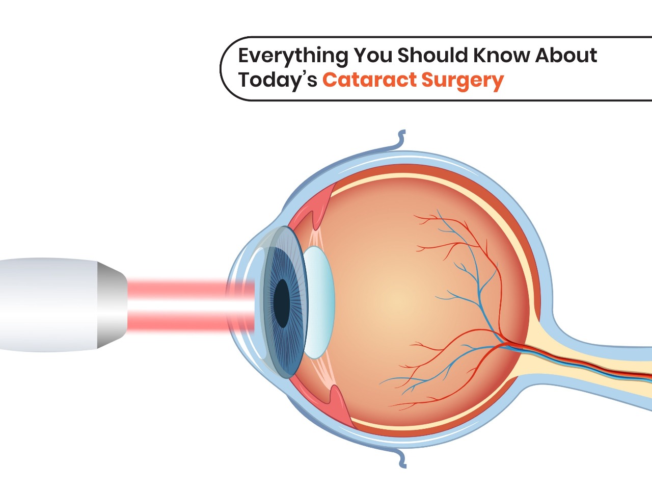 Best Cataract Surgery in KPHB Kukatpally | Medivision