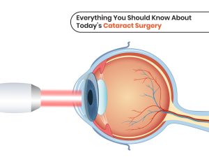 Understanding Modern Cataract Surgery